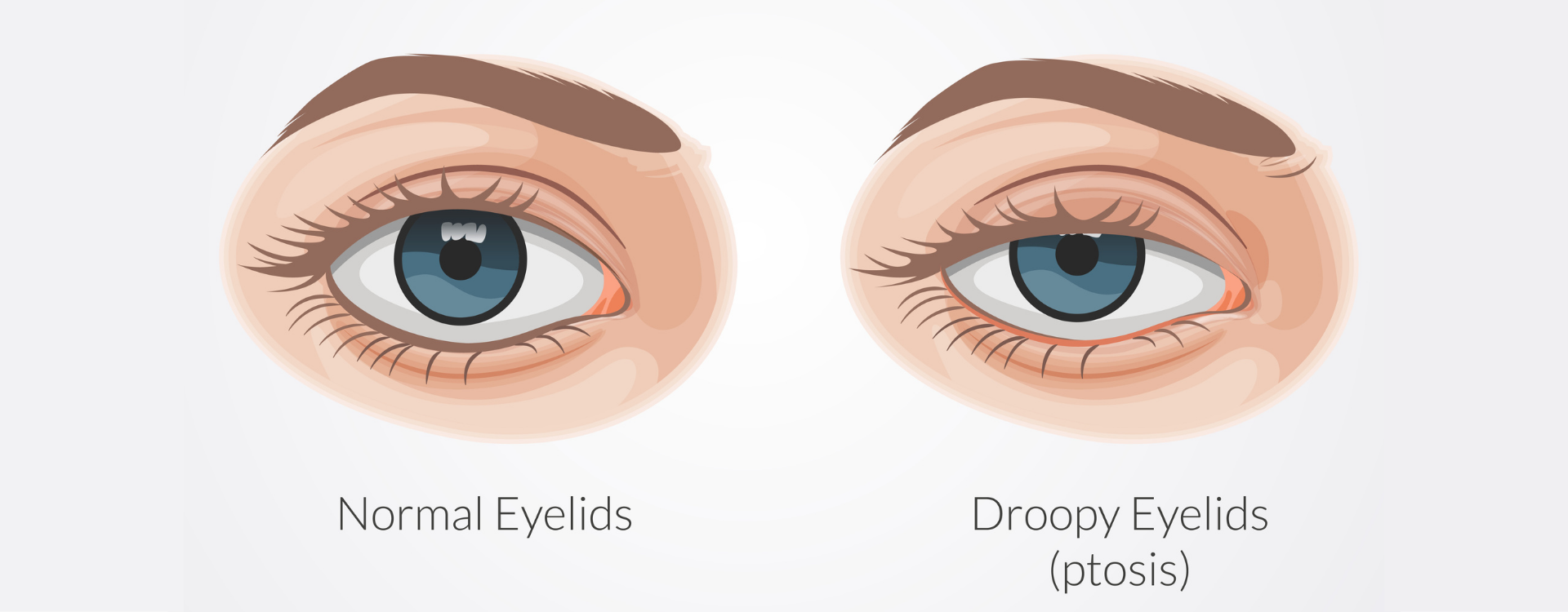 Ptosis paupi&egrave;re qui tombe causes sympt&ocirc;mes traitement et solutions