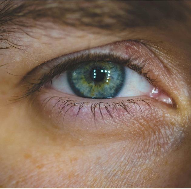 Ptosis : Comprendre la paupière tombante et les solutions disponibles