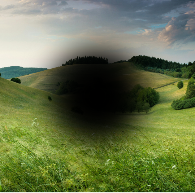 AMD : Causes, Symptoms, and Treatment of age related macular degeneration