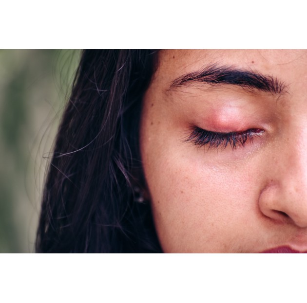 Stye: Symptoms, Causes, and Treatments